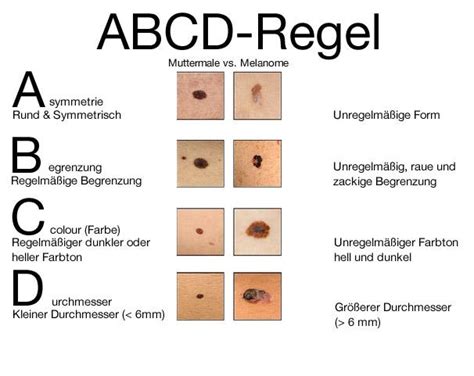 Jedes jahr werden in deutschland rund 190.000 gallenblasen operativ entfernt. Hautkrebs selber erkennen • WOMAN.AT