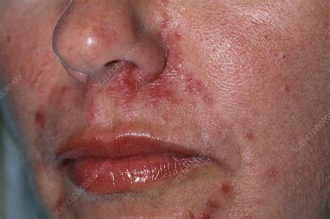 Acne Rosacea Stock Image M2500053 Science Photo Library