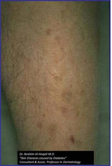 Black Spots On Legs Diabetes Diabeteswalls