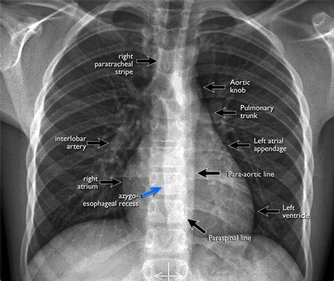 Chest X Ray Interpretation Made Easy Radiology Radiology Imaging