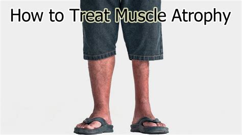 How To Treat Muscle Atrophy