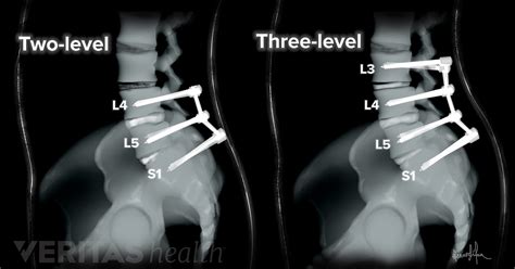 Spinal Fusion Surgery L5 S1