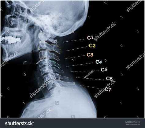 22000 Cervical Spine Image Images Stock Photos And Vectors Shutterstock