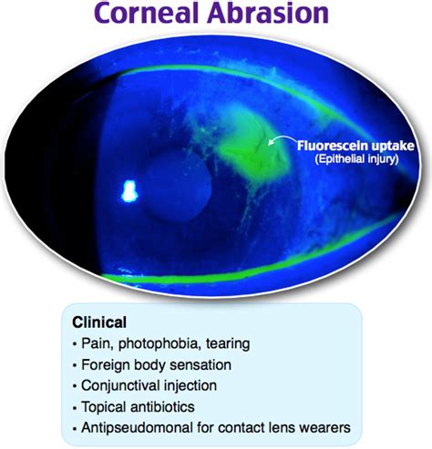 Corneal Abrasion Medical Ultrasound Optometry Education Emergency