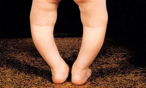 How Do I Know If My Child Has Bow Legs Vinmec