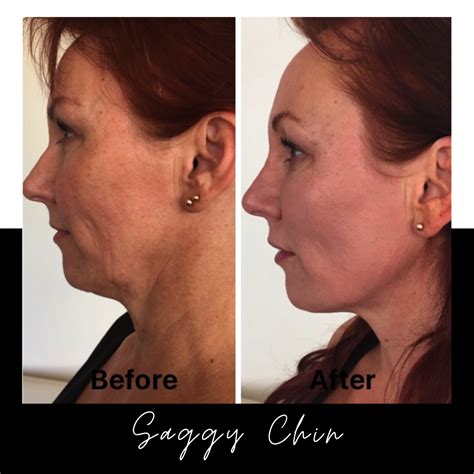 Saggy Neck Surgery Is There Another Solution