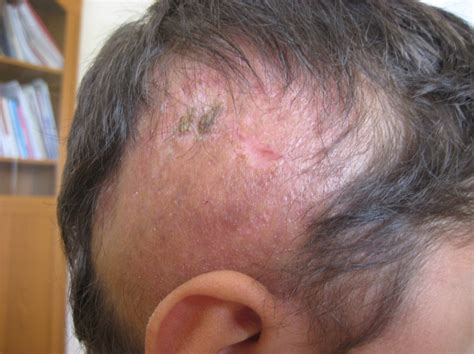 In another study, the authors found. Experimental drug reverses hair loss and skin damage ...
