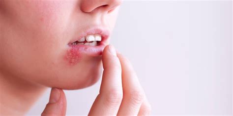 Disseminated Herpes Definition Cause Symptoms And Treatments Mse Labs