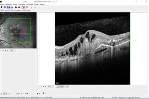 Age Related Macular Degeneration Amd Ophthalmologist Konstantinos