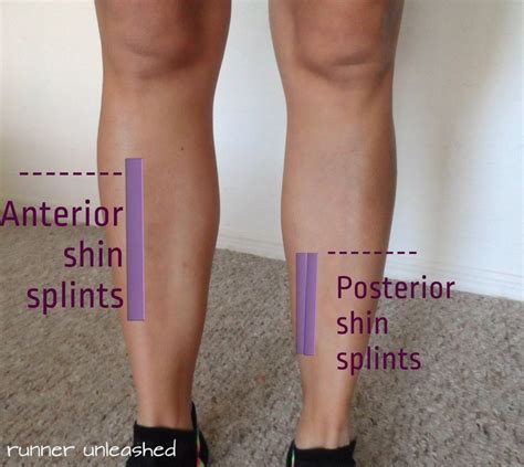 Pin On Shin Splints Symptoms