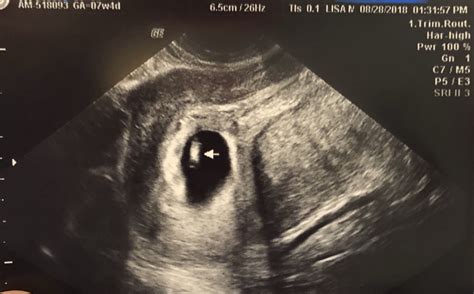 Post Your Ultrasounds Here — The Bump