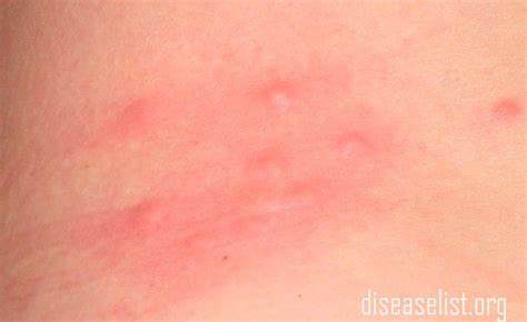 Flea Bite Pictures Treatment Symptoms On Humans