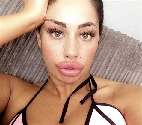 This Mum Has Already Huge Lips But She Wants Them Even Bigger Pics