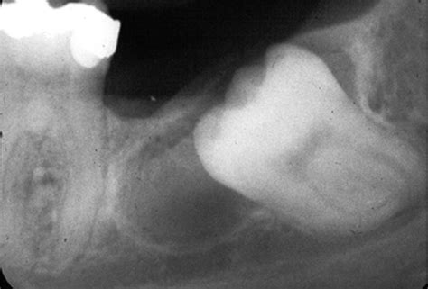 Dentigerous Cyst Dr G S Toothpix