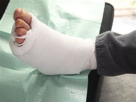 Non Removable Casts Are Better Than Dressings Or Removable Casts For