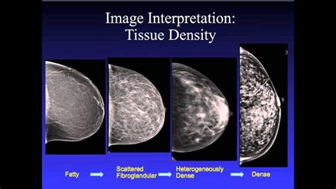 Pin On Health Mammogram Abnormal Results