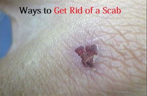 scabies removal