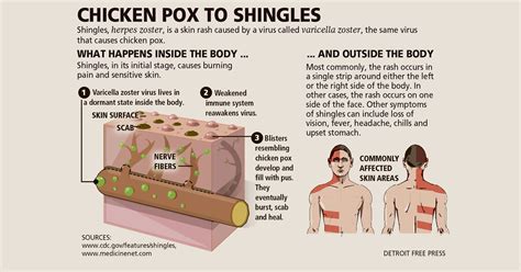 Shingles Rash On Ear