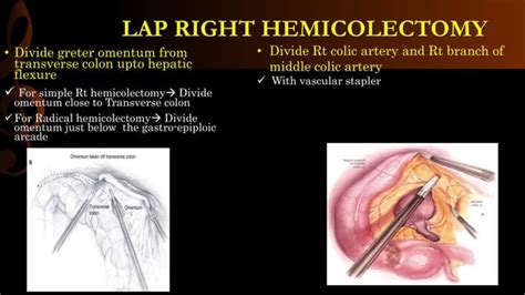 Lap Right Hemicolectomy Step By Step Operative Surgerypptx