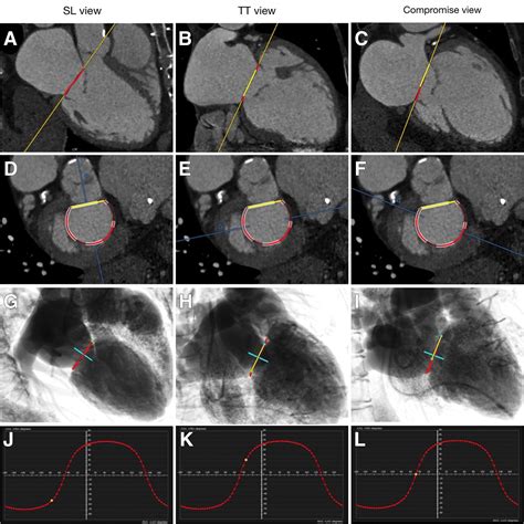 Mitral Valve Imaging With Ct Relationship With Transcatheter Mitral