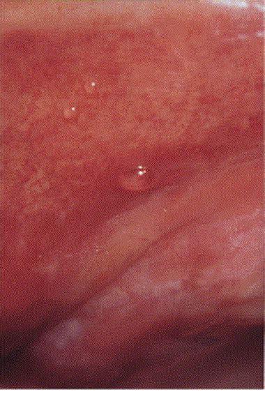 Superficial Mucocele Report Of 4 Cases Oral Surgery Oral Medicine