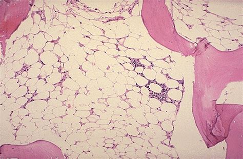 Aplastic Anemia Hematology Medbullets Step 1