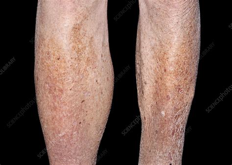 Cellulitis On Swollen Calf Stock Image C0401048 Science Photo