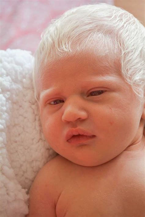 ‘our Baby Had A Head Full Of Hair — White As Snow Moms Shocked