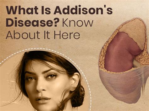 Addison S Disease Symptoms Causes Risk Factors And Treatment