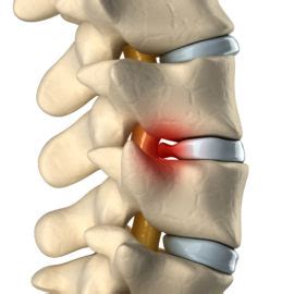 Bulging Disc Symptoms Causes And Treatments Options