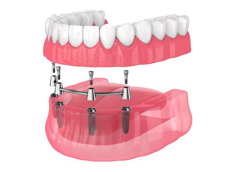 All On 4 Dental Implants Byrne Dental