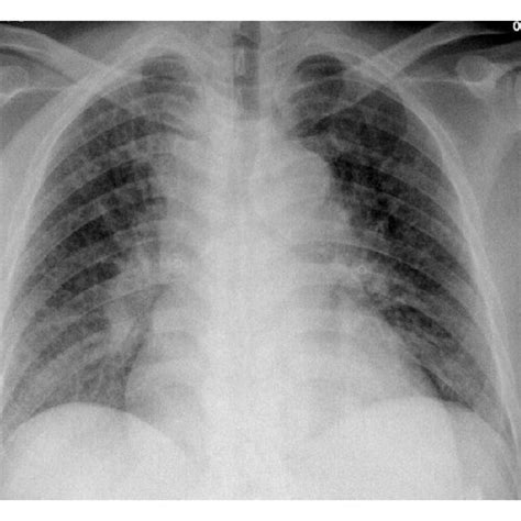 Computed Tomography Of Chest Showing Mediastinal Adenopathy With