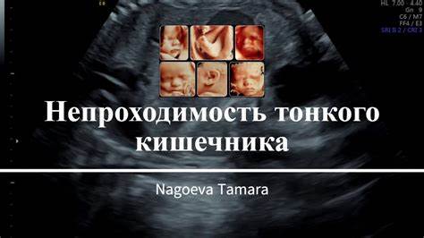 Непроходимость кишечника - YouTube Картинка - Непроходимость кишечника - YouTube