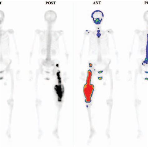 Bone Scintigraphy Examination Bone Scintigraphy Examination Revealed
