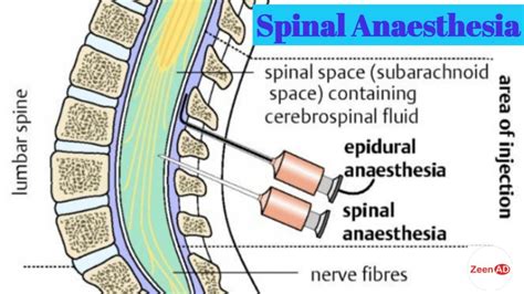 Spinal Anesthesiaprocedure Of Spinal Anesthesiaadvantages And