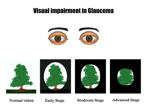 What Does Glaucoma Vision Look Like