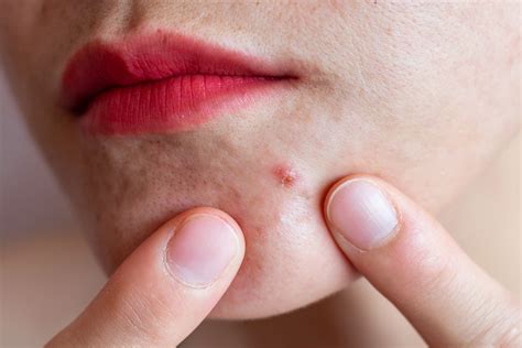 Nodular Acne Symptoms Causes And How To Treat It
