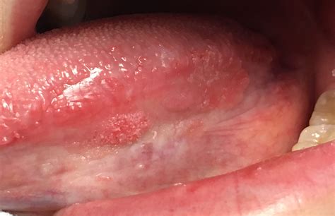 Cancer Bumps On Tongue