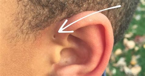 Were You Born With These Rare Tiny Holes In Your Ears Heres Why Ear