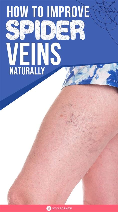 How To Improve Spider Veins Naturally Spider Veins Treat Spider Veins Get Rid Of Spider Veins
