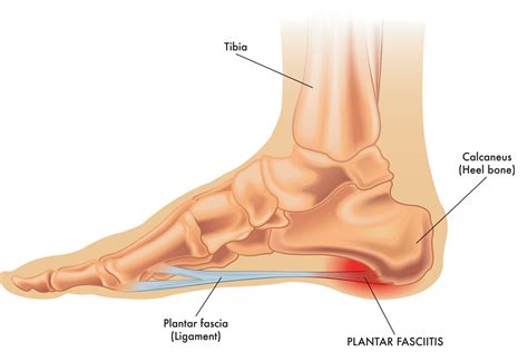 Plantar Fasciitis Symptoms Causes And Treatments Advanced Surgery Center