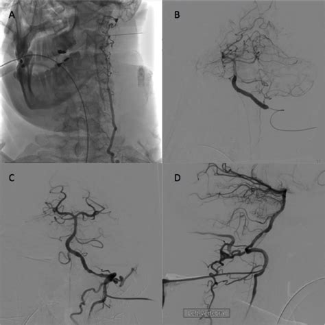 Direct Puncture Of The V3 Segment Of The Vertebral Artery