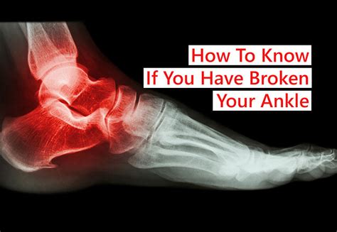 How To Know If You Have Broken Your Ankle Sports Injury Physio