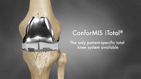 The Conformis Itotal Is The Only Patient Specific Total Knee Syst