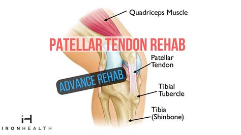 Patellar Tendon Rehab Advance Rehab Iron Health Youtube