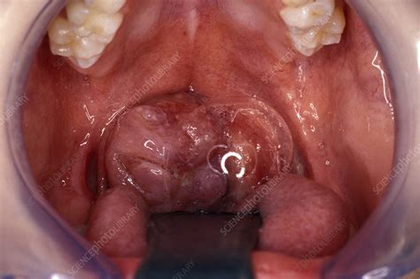 Tonsil Lymphoma Throat Examination Stock Image M1310728 Science