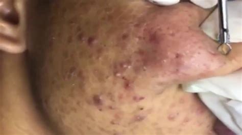 Cystic Acne Pimples Blackheads Whiteheads Extraction Acne Treatment