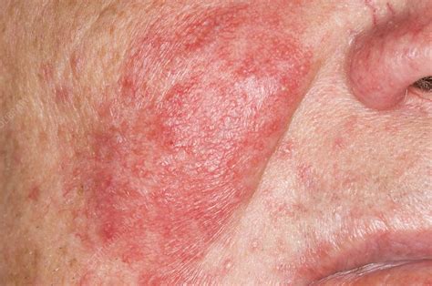 Allergic Reaction To Scabies Rash Pictures Types Of Rashes Rashes