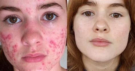 Kali Kushner Goes Viral For Before And After Acne Photos Teen Vogue