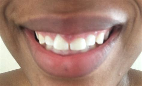 Does getting a crown hurt? severe pain in gums after a permanent crown and two ...